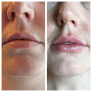 photo of a juvederm filler on lips