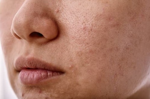 Face with uneven skin tone and texture issues that can be helped with Coolpeel in prescott Arizona from Prescotbotox.com