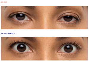 Before and after of eyes using Upneeq eyedrops