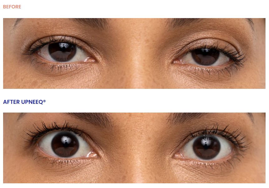 Before and after of eyes using Upneeq eyedrops