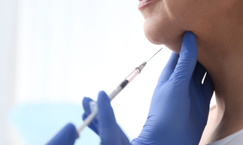 Kybella treatment for double chin