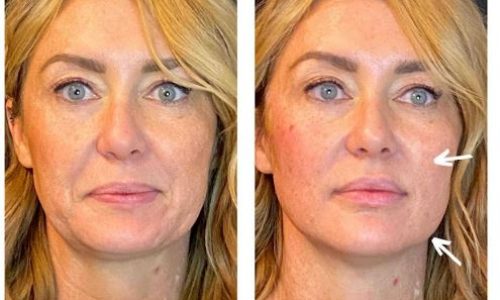 Thread lift before and after