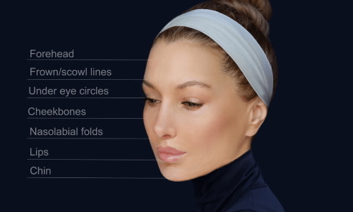 Picture showing where juvederm and other fillers go