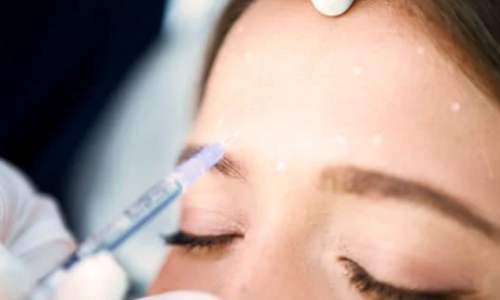 botox-areas-