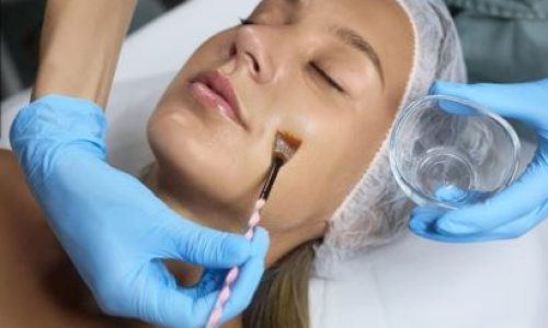 women in prescott arizona getting chemical peel