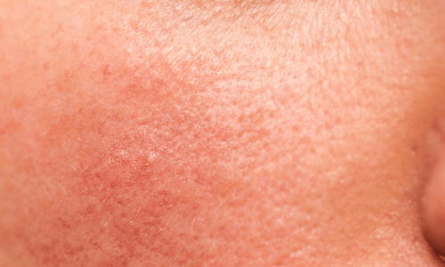 Image of skin issue that could be helped with CoolPeel laser
