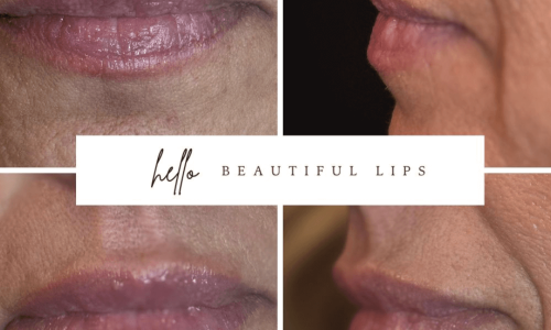 Lip filler before and after in prescott arizona