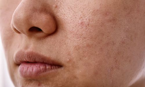 skin-texture-